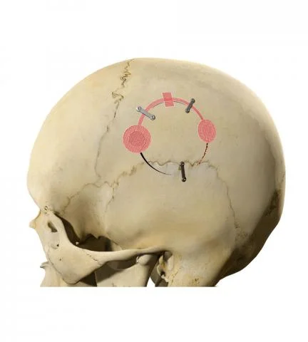 craniotomy