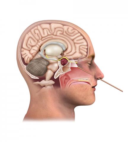Skull Base Closure